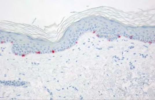 Normal Melanocytes Melan-A (Mart-1) Dispersed within the basal layer approximately one