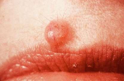 Intradermal Nevus Clinical most common type of