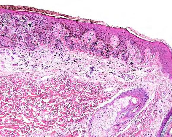 Atypical Nevus Architectural
