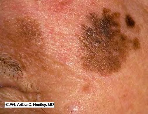 Confined to the epidermis Often found on face of elderly patients with
