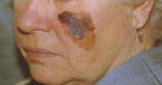 Invasive Melanoma Melanoma which has grown into the dermis This happens quickly in some patients but slowly in