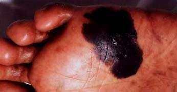 Acral lentiginous melanoma Most common type of melanoma