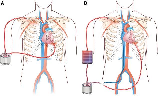 The ECMO System From: Novel minimally invasive surgical approach using an external ventricular assist device and extracorporeal membrane oxygenation in refractory cardiogenic shock Eur J Cardiothorac