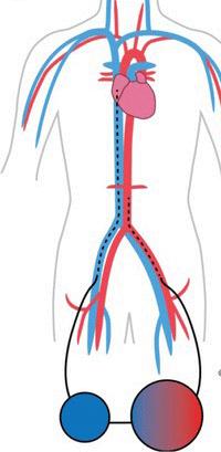 Basic Modes of ECMO VA ECMO Vein-ECMO-artery