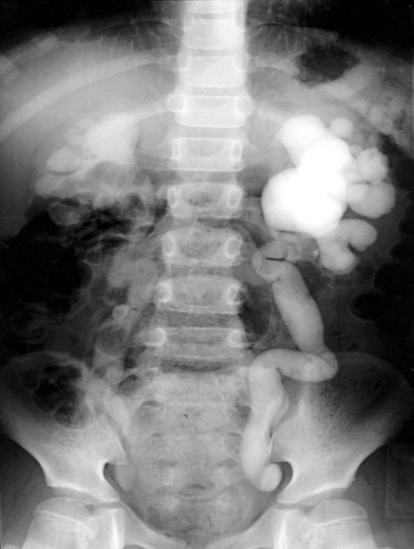 This revealed bilateral hydroureteronephrosis with delayed excretion (T1/2 right 789 minutes and left side 24 minutes).