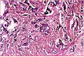 hyperplasia with localized proliferation of the glands 2(a) Gleasons pattern-3 varying size and shape of the