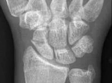 Management of Scaphoid Fracture Non operative Treatment Non displaced, acute distal fractures Waist fractures in patients who need/want to avoid surgery Thumb spica cast 6 12 weeks for distal