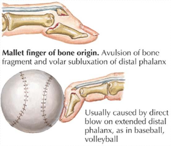Diagnosis of Mallet Finger History Sudden forced flexion of DIP during active extension (jammed finger) Distal phalanx stays in flexion can t straighten my finger Following trauma Exam Distal