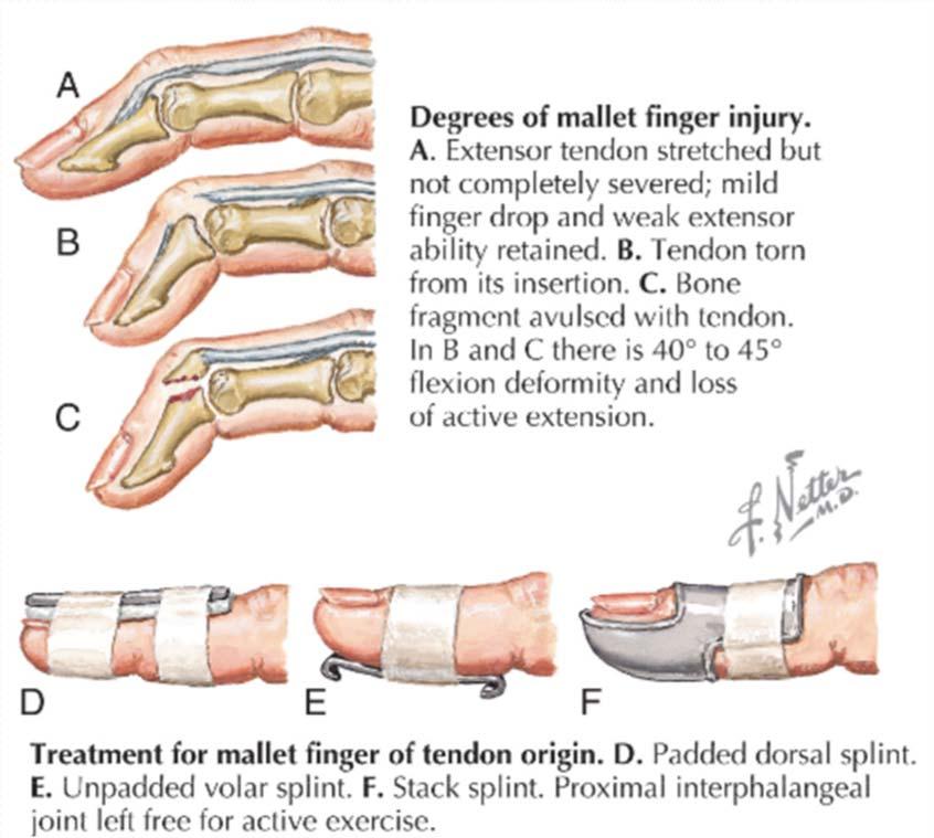 Management of Mallet Finger Full time splinting of the DIP joint in full extension for 6 8 weeks Leave PIP joint free to maintain