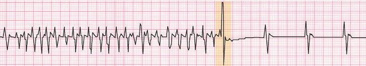 Shock the heart: If the heartbeat becomes too fast, the ICD may use cardioversion (several light shocks) or defibrillation (one strong shock) to stop the heartbeat.