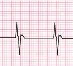 The ICD sends out impulses that keep the heart beating at a minimum pace.