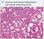 NASH (Non-alcoholic steatohepatitis) = fat + inflammation Proportion of NAFLD will have NASH Fibrosis (liver damage) stages: