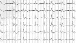 Diagnostic tools: EEG: periodic