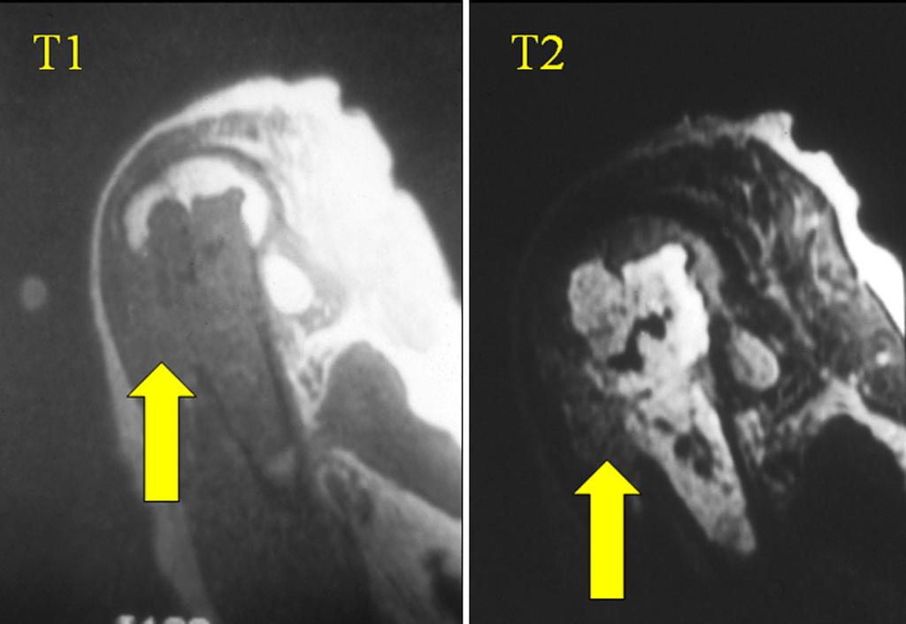 Soft Tissue Neoplasm Radiographs only occasionally helpful CT and more often MRI can be tissue specific But.