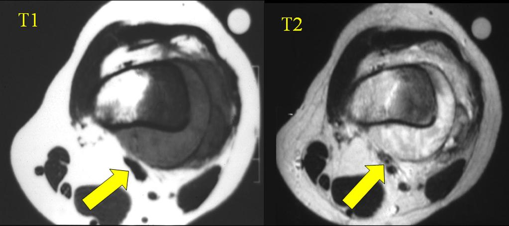 Improved contrast resolution Multiplanar MR images and MRA findings of stenosis 9% in soft tissue sarcomas; 3.