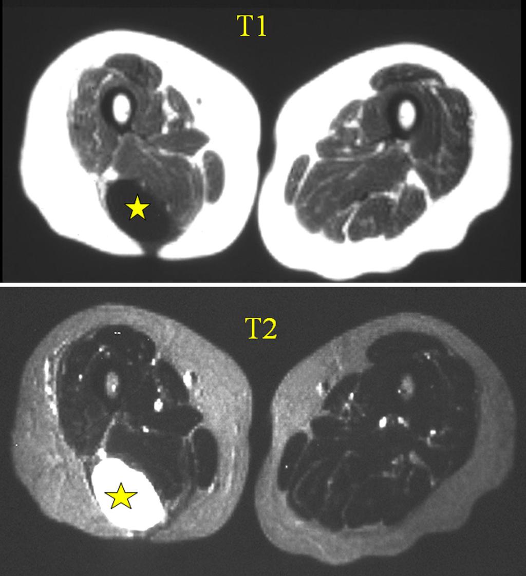 Figure 26 Myositis ossificans with early rim of ossification (arrow) on CT image (same patient as previous MRI).