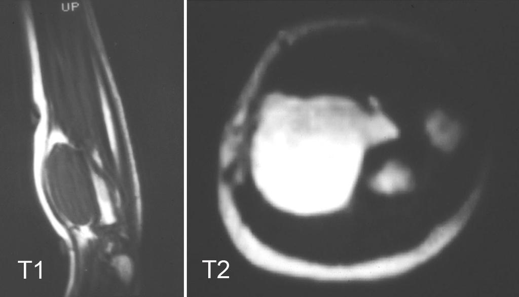 Fluid collections: subfascial, lymphocele/seroma Postoperative Imaging MRI/CT: Abnormal [Figures 28 & 29] New bone destruction/marrow replacement Any recurrent or residual nodular region Tumor until