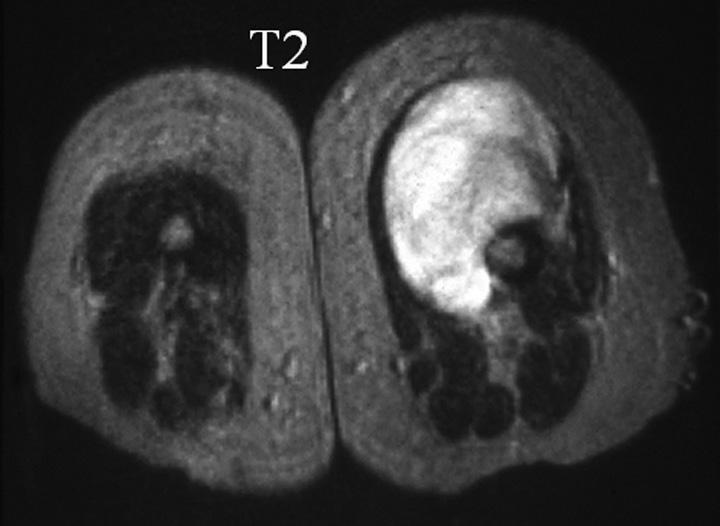 Musculoskeletal Neoplasm Use of MRI with Gadolinium [Figure 30] Increase lesion conspicuity (usually not needed) Tumor, edema, inflammation, and fibrosis all enhance Help differentiate