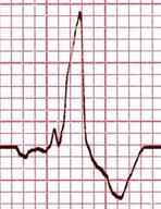 Elements that suggest RVH in in the presence of IRBBB and CRBBB IRBBB QRS duration < 120 ms CRBBB QRS duration 120 ms Isolated IRBBB R < 10 mm Isolated CRBBB R < 15 mm rsr