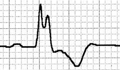 dislocation of QRS loop with CW