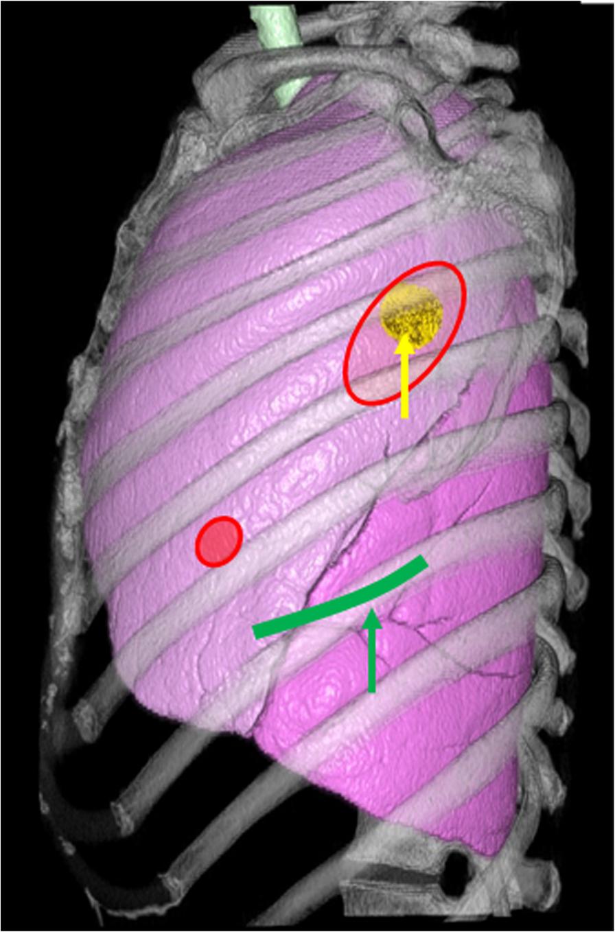 Matsuoka et al. Journal of Medical Case Reports (2019) 13:1 Fig. 3 Three-dimensional image reconstructed from computed tomography with operative images.