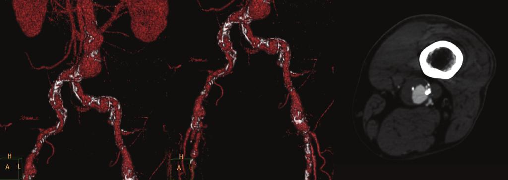 2 Case Reports in Vascular Medicine (a) (b) (c) Figure 1: Three-dimensional reconstruction of computed tomography angiography illustrating the infrarenal abdominal aortic aneurysm (a) and aneurysms