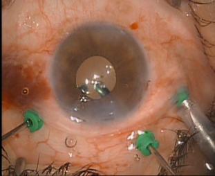 MANAGEMENT Vitrectomy: Required for the treatment of certain complications (vitreous