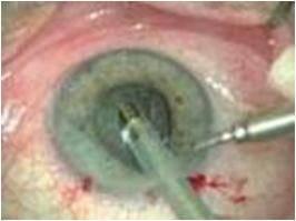 MANAGEMENT Cataract surgery: - Indicated if visually significant