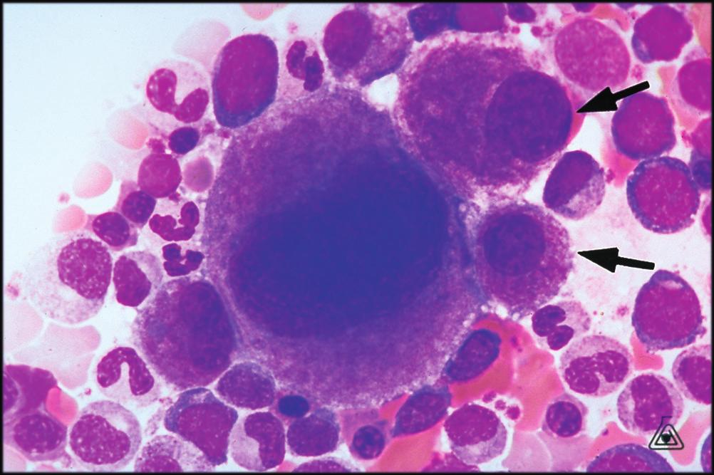 HE-45, 1995 (Bone Marrow, Wright-Giemsa, X313) precursor, abnormal 73.9 58.8 precursor, normal 21.7 24.6 Megakaryocyte nucleus 4.2 0.3 Osteoblast - 2.6 Plasma cell, immature - 2.