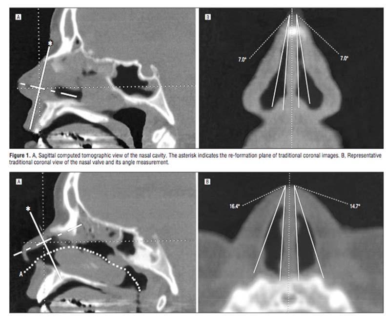 Imaging Testing Objective Airflow Evaluation Acoustic Rhinometry Validated technique, but controversial Used clinically in Europe