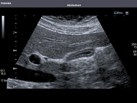 Gallbladder PoCUS PoCUS GB assessment Size - (Contracted, Easily