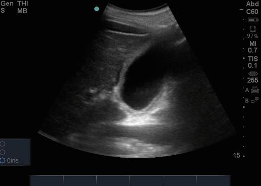 Gallbladder PoCUS PoCUS GB assessment Size - (Contracted, Easily visible, Distended) GB wall thickness - (anterior wall, < 3mm) 10mm