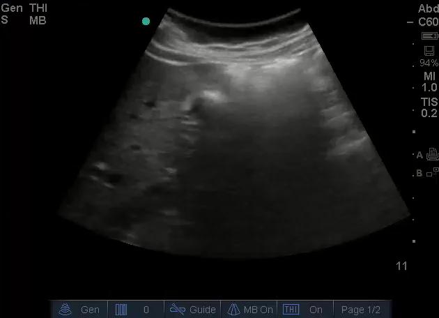 Gallbladder PoCUS PoCUS GB assessment Size - (Contracted, Easily visible, Distended) GB wall thickness - (anterior wall, < 3mm)