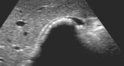 Gallbladder PoCUS Pitfalls Bowel loop vs contracted GB full of stones Loop of bowel can