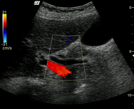 CBD PoCUS Long Axis Rotate to align with long axis portal vein Identify CBD (*) lying anterior to portal vein (^) Right