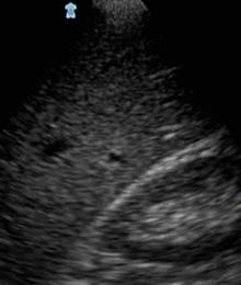 Renal PoCUS Patient supine Liver is the acoustic window for the right kidney Find hepato-renal interface in coronal