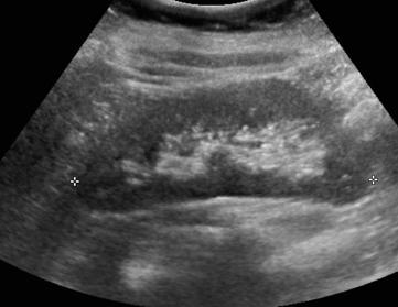 Renal PoCUS Modifications Views may be improved by LIVER STOMACH rolling patient onto side I