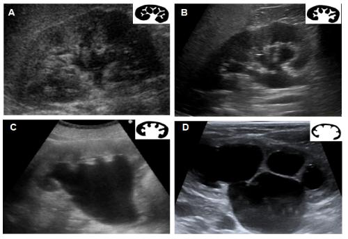 PoCUS Hydronephrosis Grade I: Dilatation of the renal pelvis (< 5-7mm) without dilatation of the calices. Grade II: Dilatation of the renal pelvis (< 10mm) and calices.