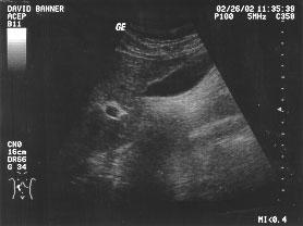Gallbladder Pear shaped anechoic cyst GB fossa
