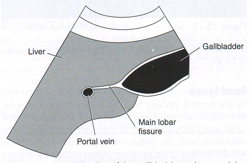 to Main Lobar Fissure (MLF) replace MLF thin