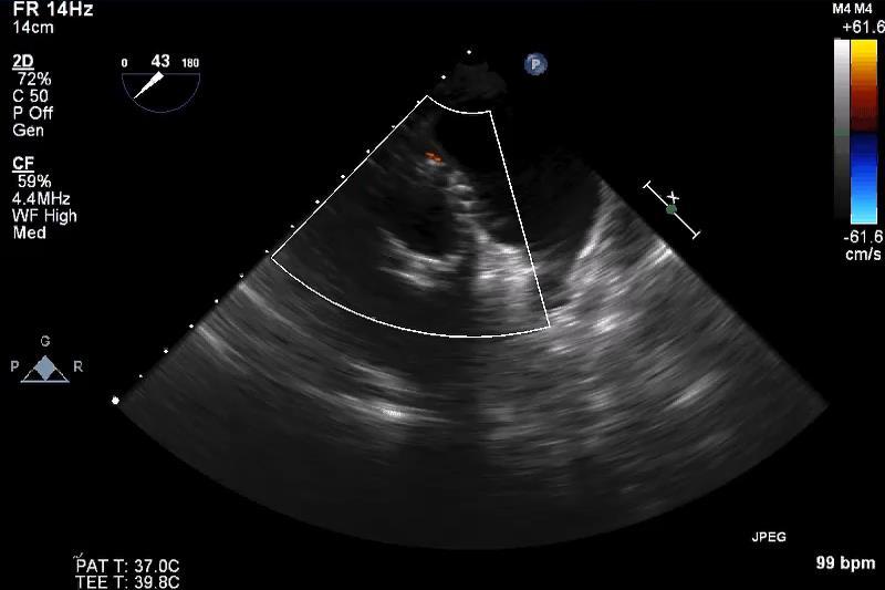 TRANSESOPHAGEAL ECHO Significant Paravalvular Aortic