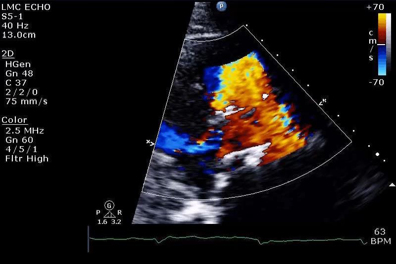 Several Weeks Post CoreValve Severe new-onset heart failure with