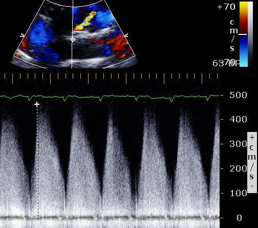 region to RVOT  with normal LVEF Systolic AND diastolic flow