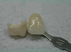 Figure 3 Figure 4 InSync Zr is an ideal ceramic for layered zirconia copings, press to zirconia, as well as staining/glazing full contour restorations.