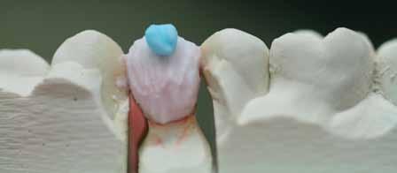 A slight amount of A1 dentin is added to the outside borders of the occlusal table (Figures 8-10).