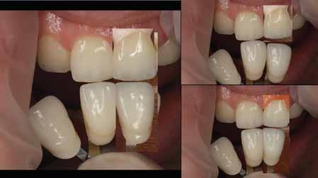There is a high degree of shade consistency delivered with a simple two powder dentin and enamel build up.