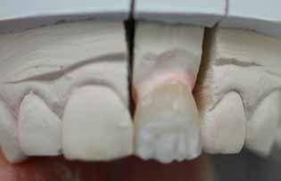 Unfortunately, a part of this rigorous verification is the need for the constant altering of the ceramic restorations until it has passed my tests.