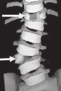 Why is it called congenital scoliosis? Congenital scoliosis is an abnormal curve or twist of the spine that is caused by the way the spine bones (vertebrae) are formed.
