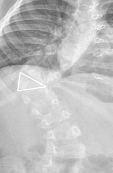 What types of operations are used in the treatment of congenital scoliosis? 1.