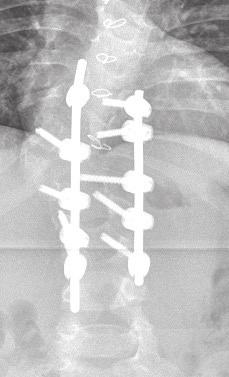 The goal of an in situ fusion is to eliminate the growth of the abnormal vertebrae to prevent further worsening of the curve.